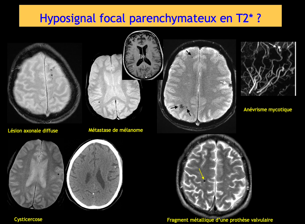 DIU d'Imagerie Neurovasculaire de l'Université Paris Cité 2024 – 2025