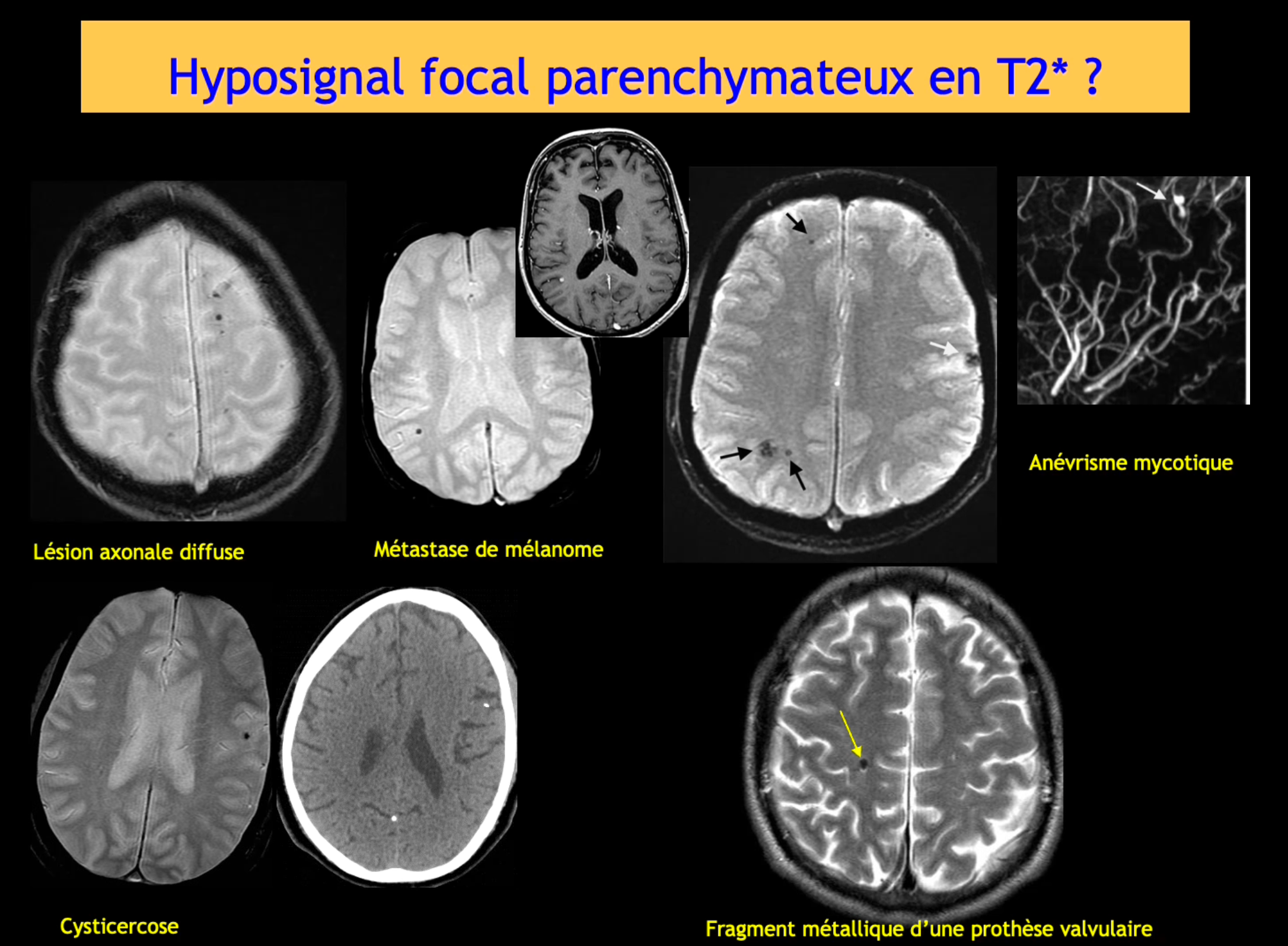 DIU d'Imagerie Neurovasculaire de l'Université Paris Cité 2024 – 2025