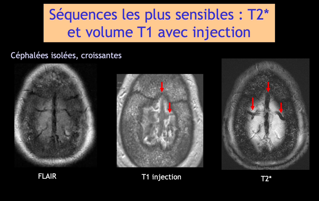 DIU d'Imagerie Neurovasculaire de l'Université Paris Cité 2024 – 2025