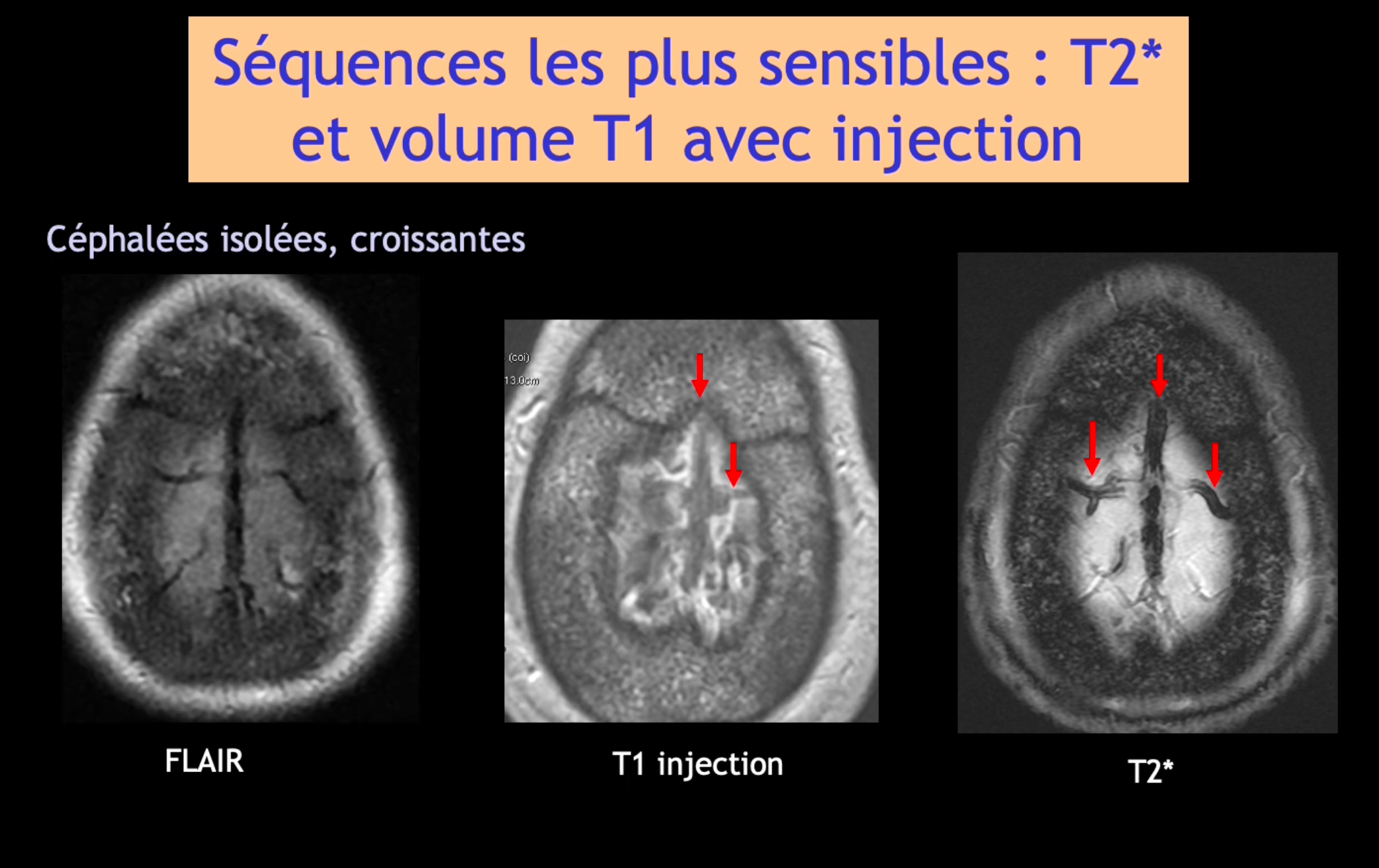 DIU d'Imagerie Neurovasculaire de l'Université Paris Cité 2024 – 2025